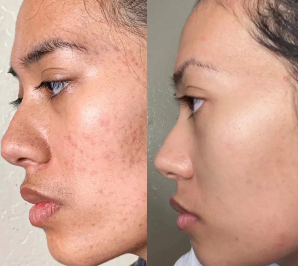 Lotion, and Skin Skins Body Acne Face Anything 10oz Oily